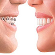 Lumineers vs. Braces