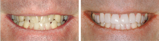 Before and after smile photograph 1