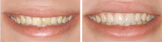 Before and after smile photograph 2