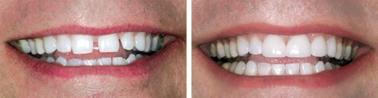 Before and after smile photograph 3