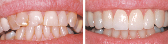 Before and after smile photograph 4