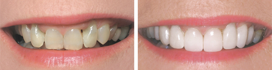 Before and after smile photograph 5