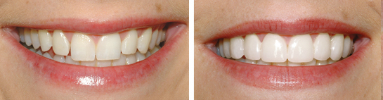 Before and after smile photograph 6