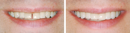 Before and after smile photograph 7