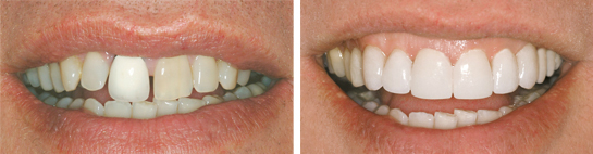 Before and after smile photograph 8